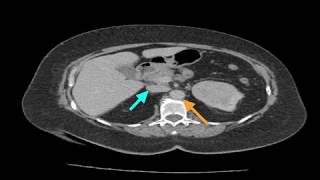 Clinical Case Renal Cell Carcinoma [upl. by Socrates252]