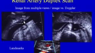 Renal Artery Duplex Scan [upl. by Enogitna152]