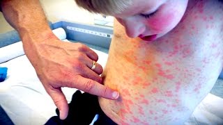 IMPRESSIVE FULL BODY RASH  Live Diagnosis With Dr Paul [upl. by Nostrebor]