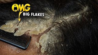 Dandruff Removal Big Flakes Satisfying 811 [upl. by Ecienahs]