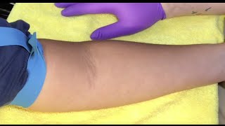 Tips For Locating Difficult Veins [upl. by Yelssew514]